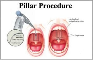 pillar procedure price